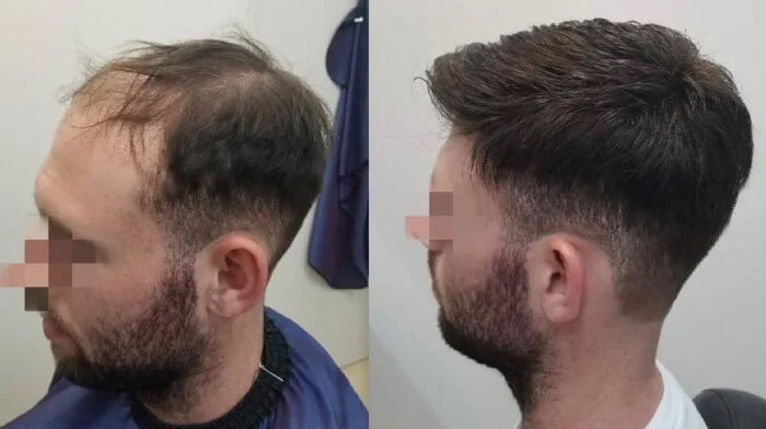 Hairline Enhancement